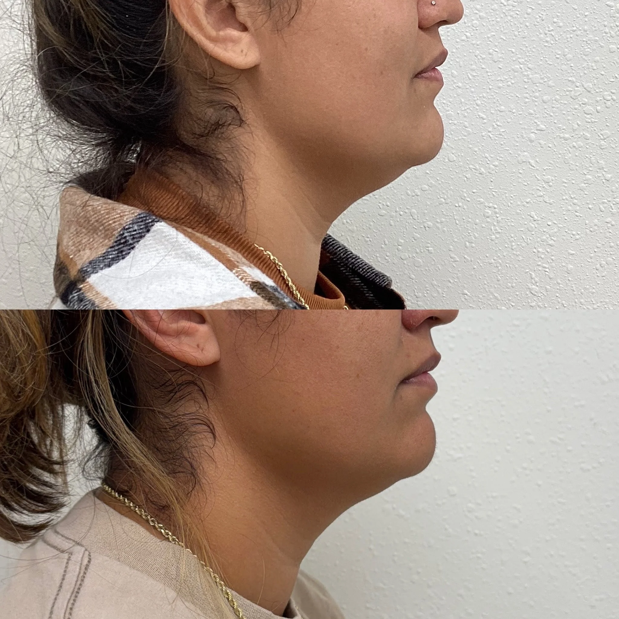 Say Goodbye to Stubborn Fat with PCDC