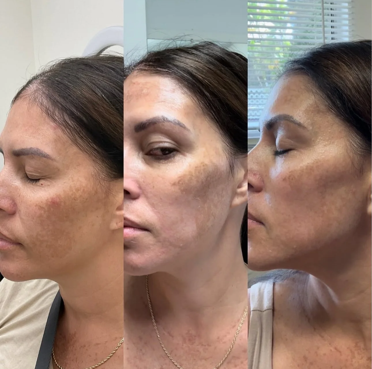Everything you need to know about TCA peels