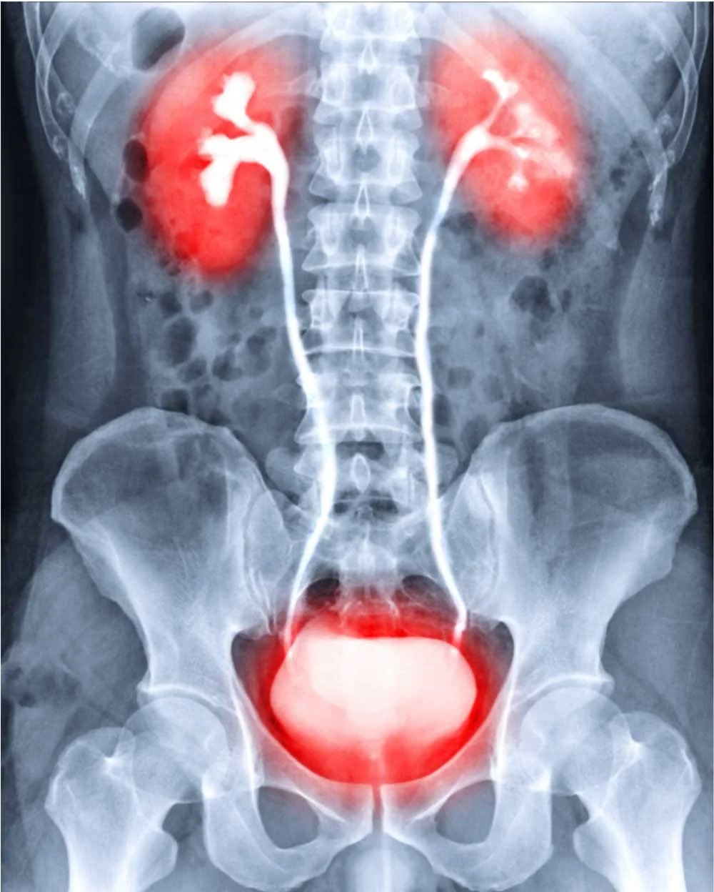X-ray image of the urinary system highlighting the kidneys and bladder with red overlays.