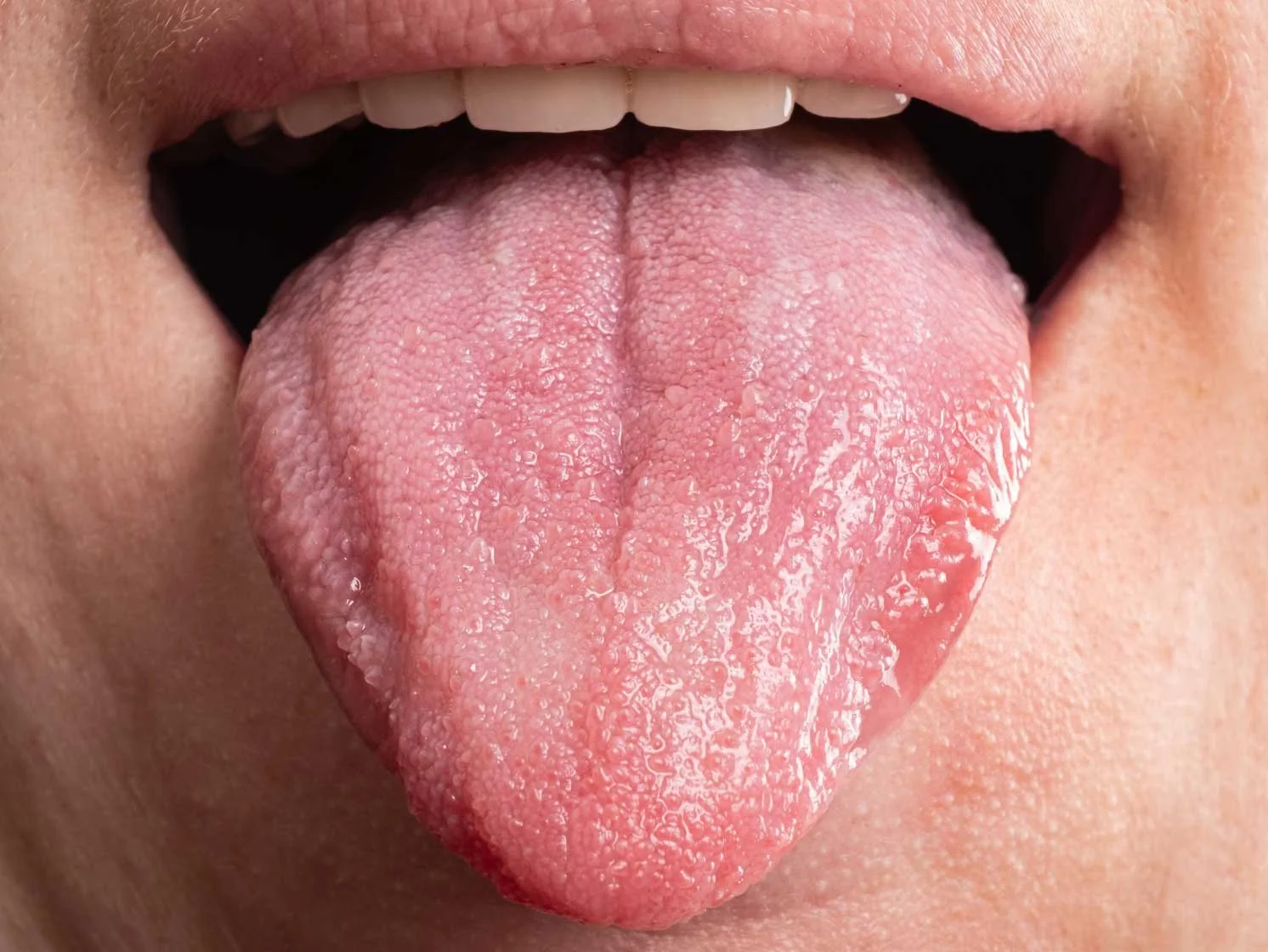 Oral Cancer's Tendency to be "Multifocal" – Meticulous Tracking is Vital!