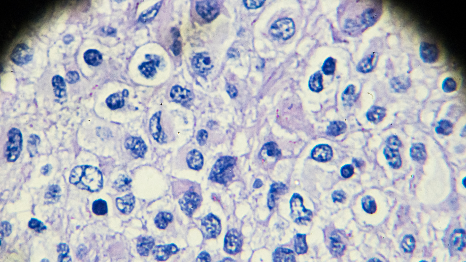 Beating the Odds With Triple Sequential Transplants
