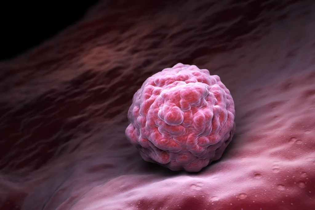 Wrestling With Shape-Shifting Germ-Cell Tumors: Lessons From KFSYSCC’s Pediatric Cancer Team