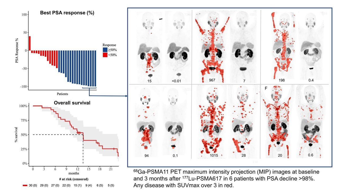 Lu-177–PSMA Therapy Arrives in Taiwan: A New Lifeline for Men With Advanced Prostate Cancer