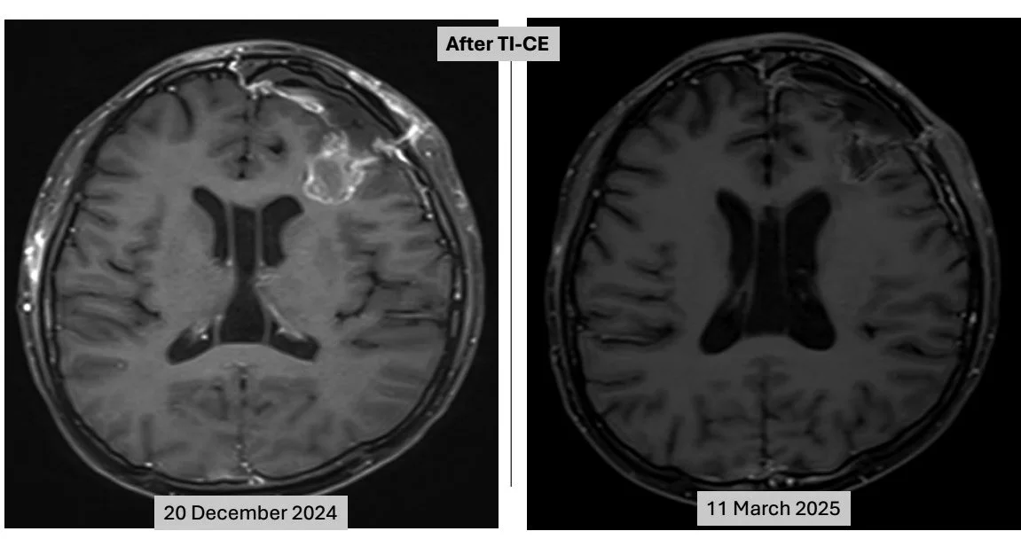 Interview with Dr. Rong-Long Chen, Pediatric Cancer Multidisciplinary Team: The Key to Curing Metastatic, Relapsed Germ-Cell Tumors with Triple-Tandem Transplantation