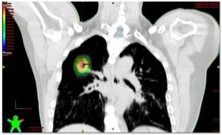 Medical scan showing a cross-section of a human chest with a highlighted area indicating concern in the lung, possibly a tumor or abnormal growth.