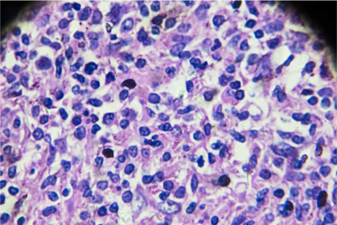 Microscopic view of a tissue sample showing densely packed dark purple stained cells with prominent nuclei.