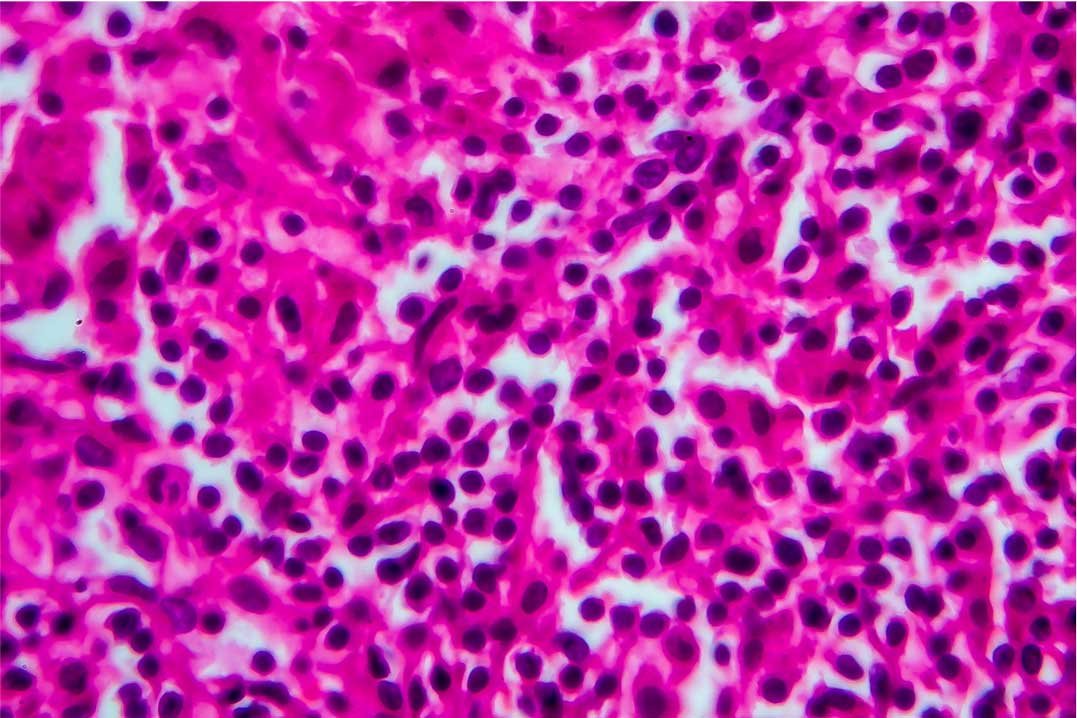Microscopic view of densely packed pink and purple stained cells, likely a tissue sample.
