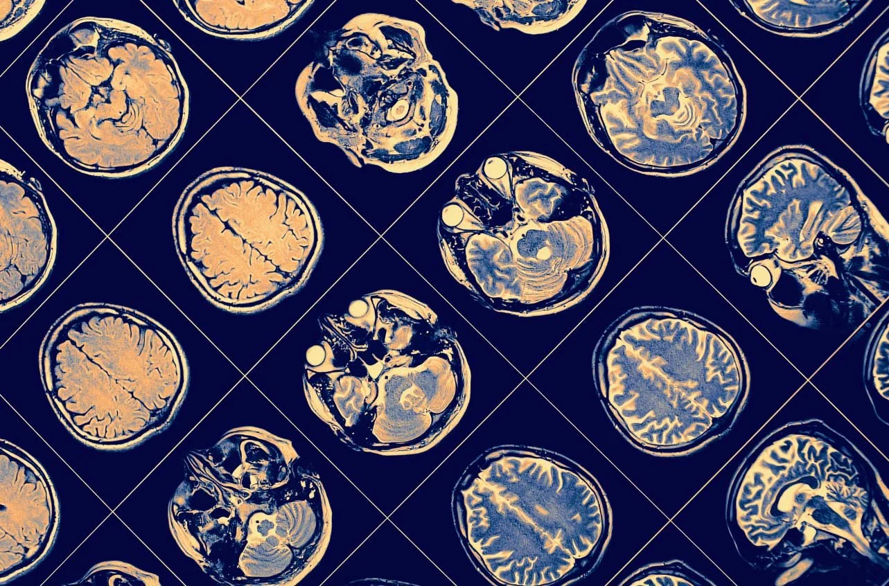 Multiple MRI brain scan images arranged in a grid pattern on a dark background.