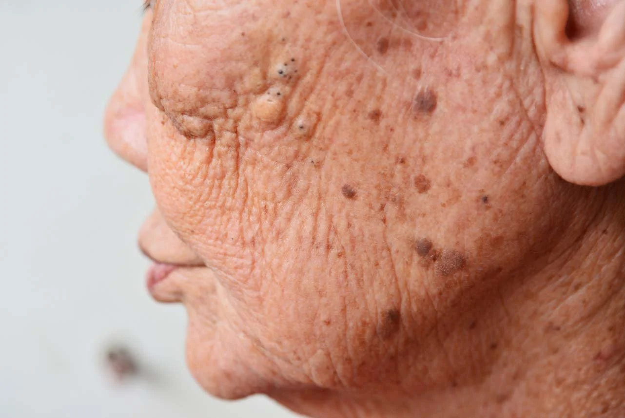 Close-up of an elderly person's cheek with age spots, wrinkles, and textured skin.