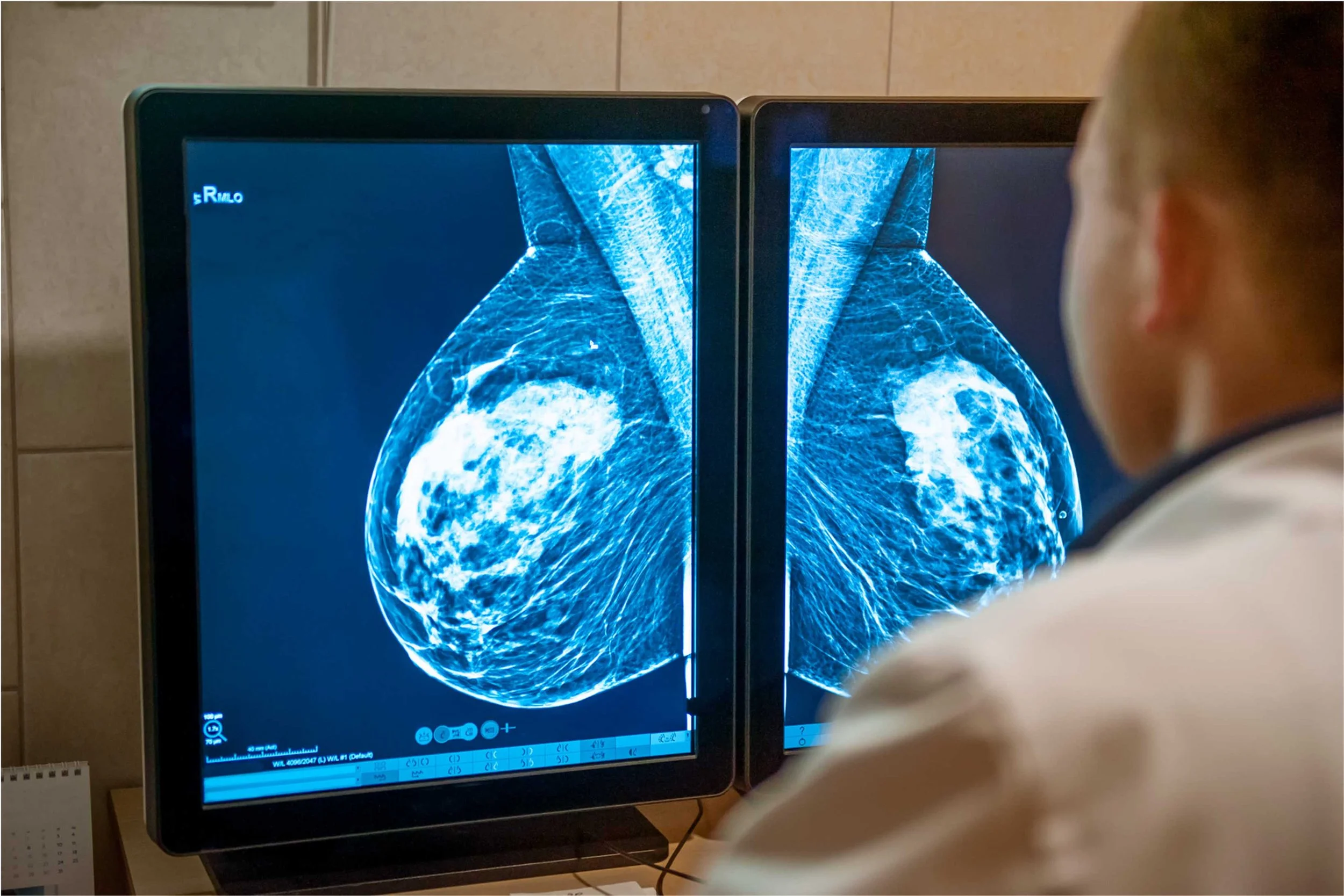 A person in a white lab coat looking at breast X-ray images on dual computer monitors in a medical setting.