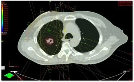 Medical scan showing a cross-sectional view of a chest cavity with lungs and heart.