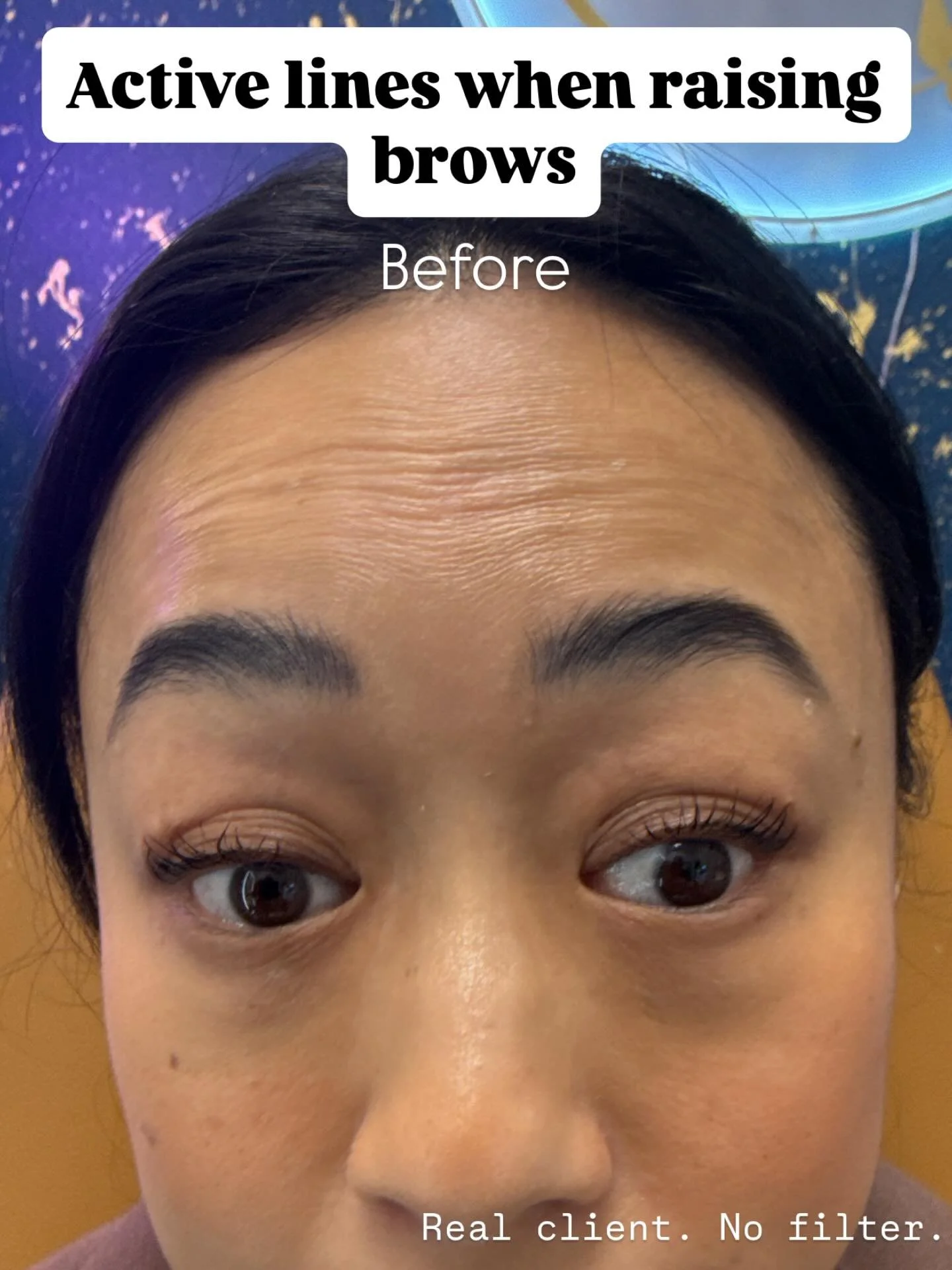 Smooth, lifted, and still expressive. This forehead tox transformation shows how subtle tweaks can create a fresh, rested look without freezing your face.
Most clients see full results in 10&ndash;14 days and enjoy smoother skin for 3&ndash;4 months.