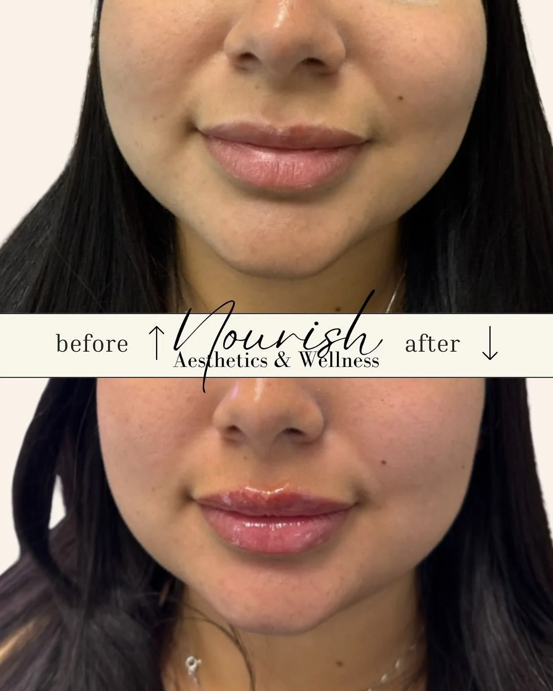 💋Subtle symmetry makes all the difference 💫
Just &frac12; syringe of RHA&reg; filler was all it took to restore balance and enhance this beauty&rsquo;s natural lip shape.
⠀
Sometimes less truly is more &mdash; when artistry meets precision.
⠀
✨ Cor