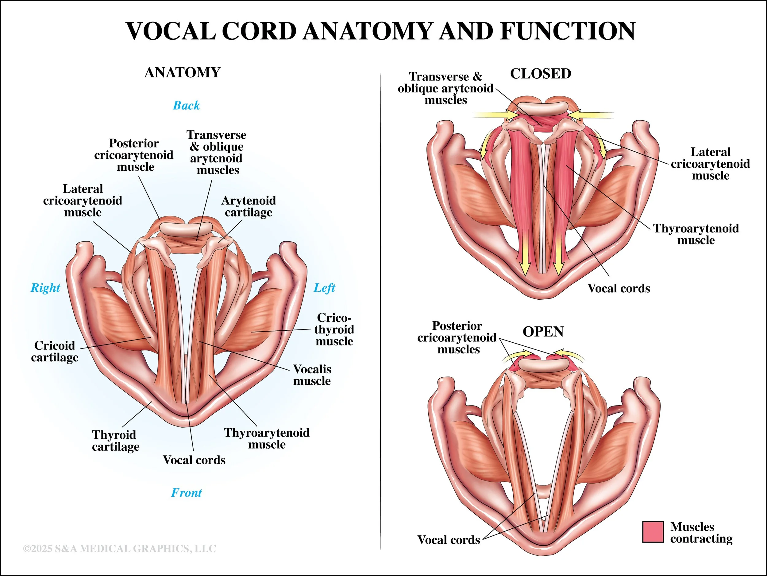 Medical Legal Exhibit | Made as medical illustrator for S&A Medical Graphics LLC