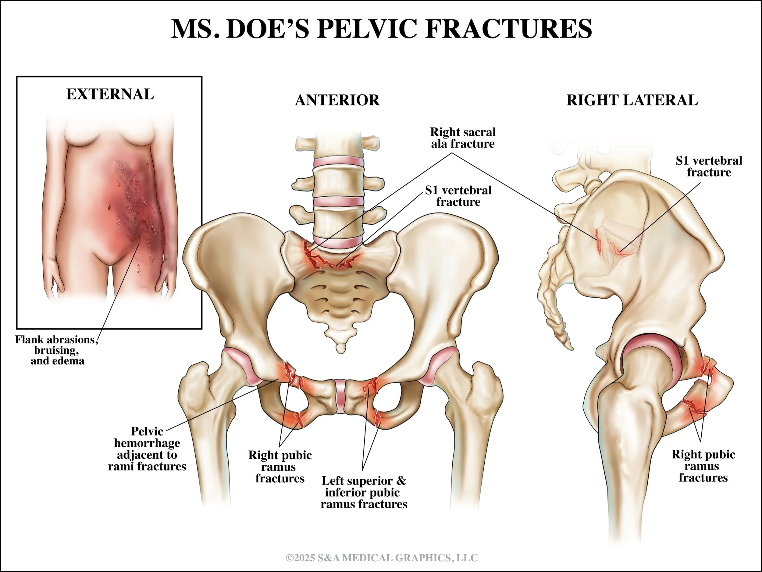 Medical Legal Exhibit | Made as medical illustrator for S&A Medical Graphics LLC | Patient Identity Anonymized for HIPPA