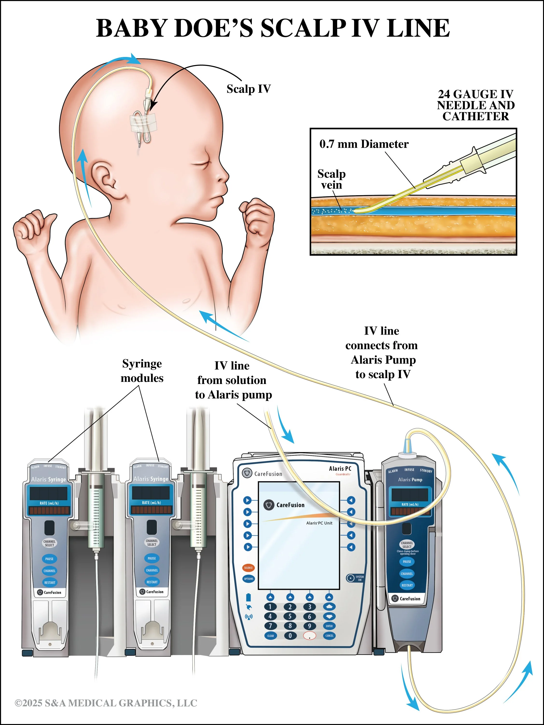 Medical Legal Exhibit | Made as medical illustrator for S&A Medical Graphics LLC