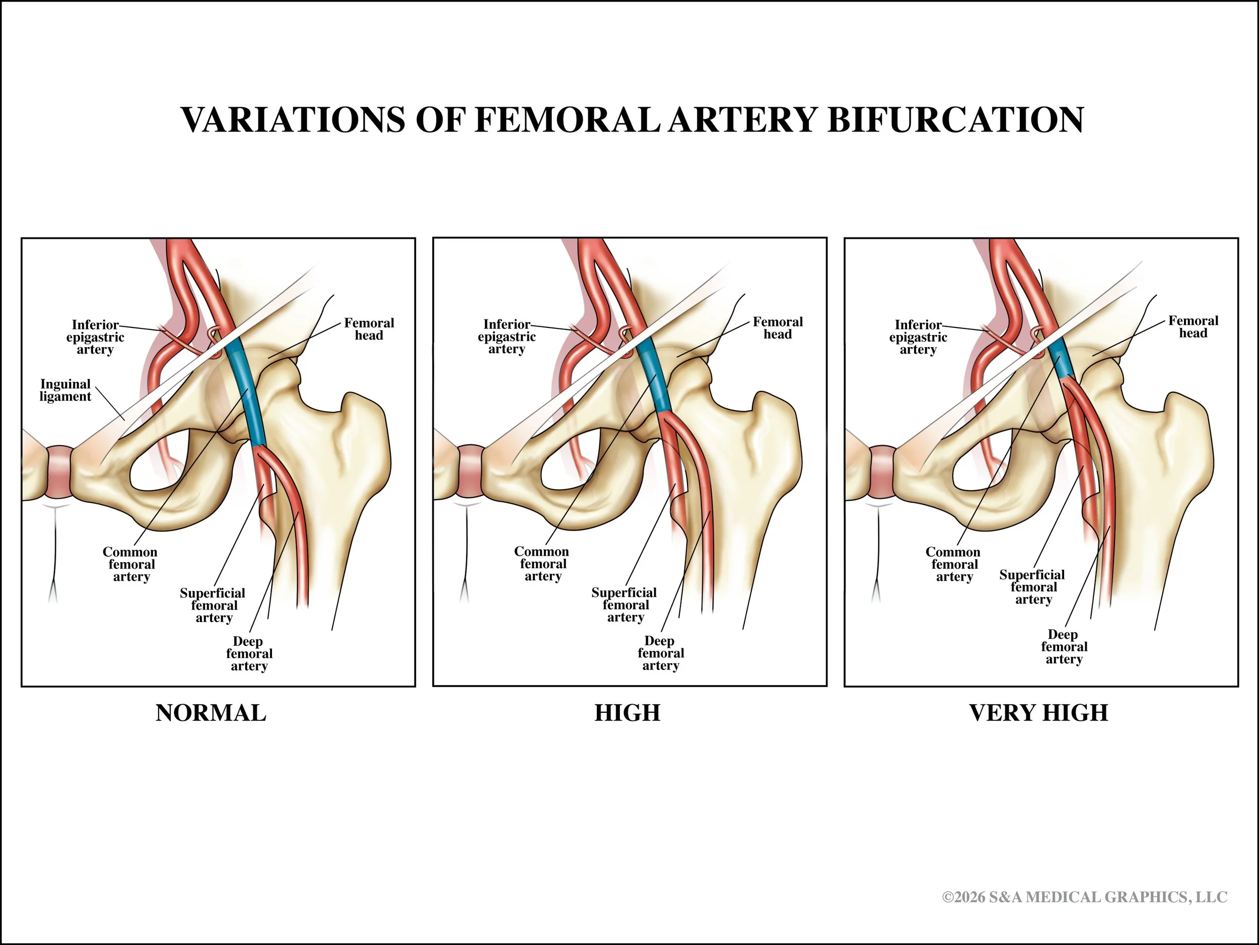 Medical Legal Exhibit | Made as medical illustrator for S&A Medical Graphics LLC