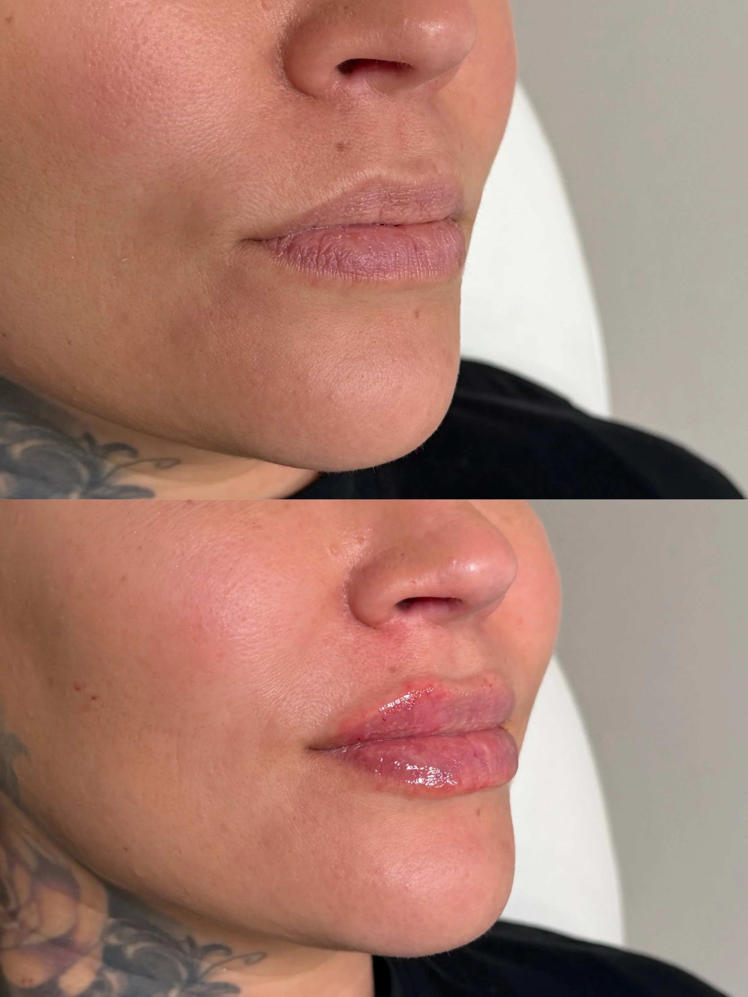 pasadena lip filler