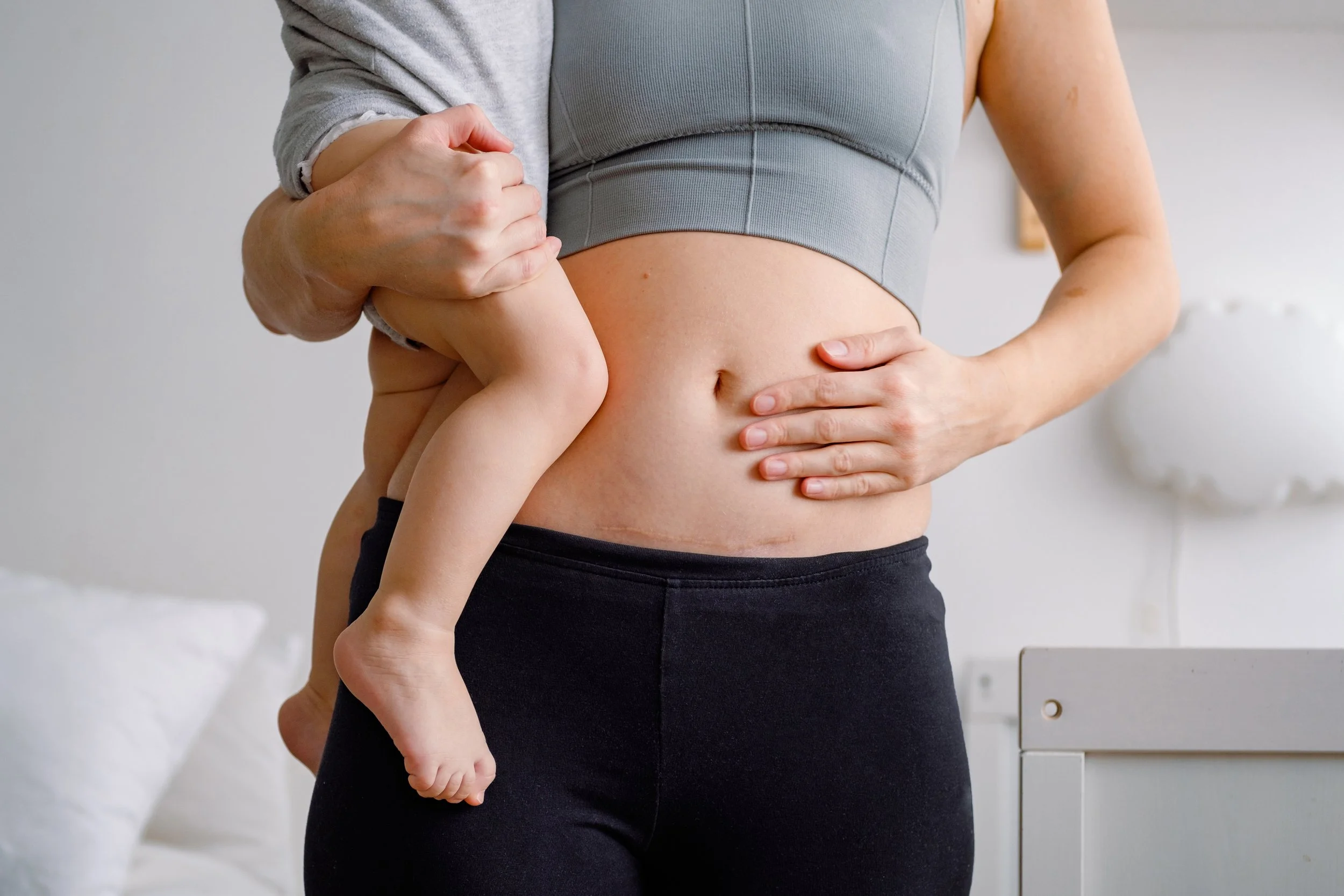 Can I Get a Mommy Makeover After a C-Section in Tampa?