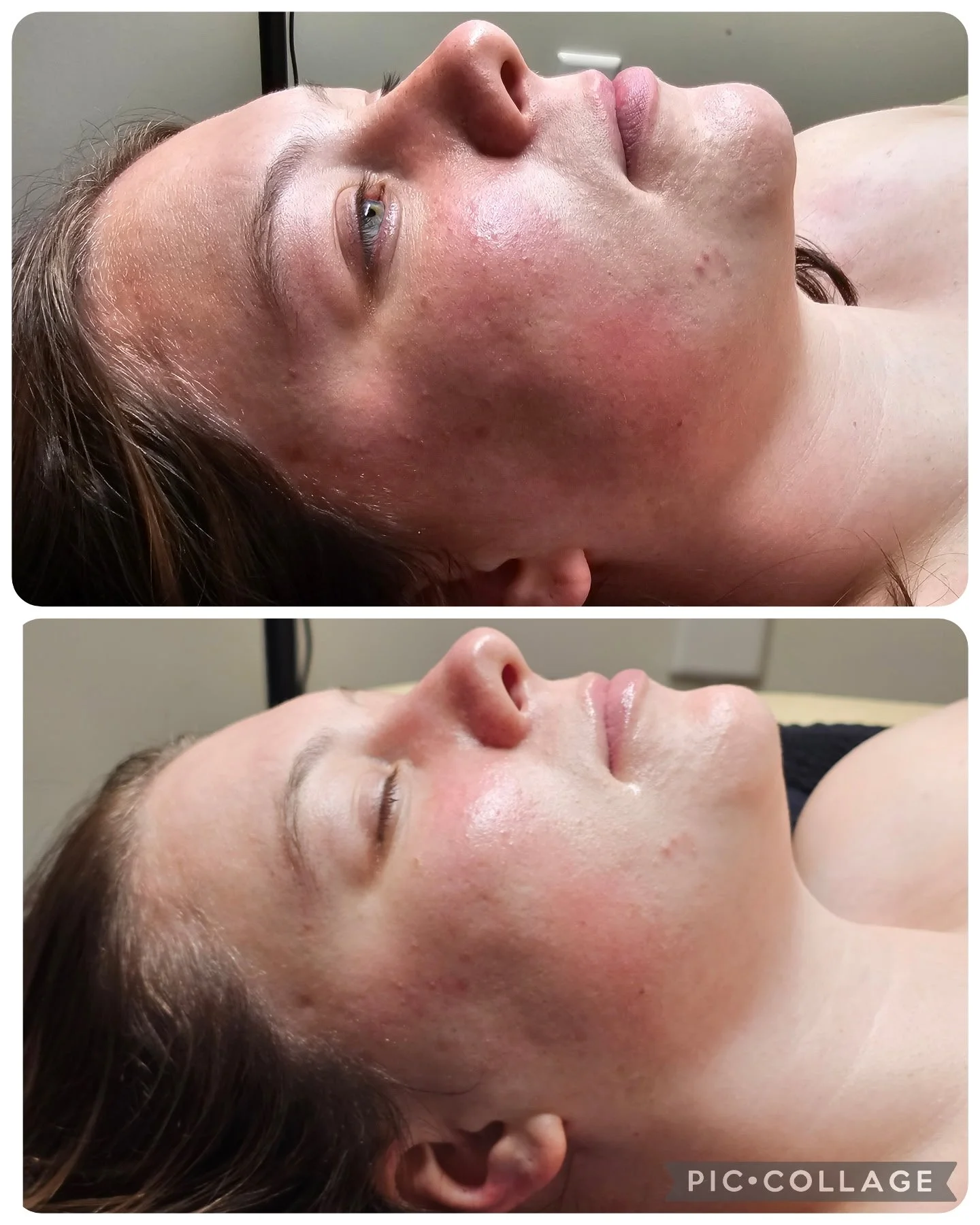 ✨ Before &amp; After: Custom Facial Results ✨
Facials aren&rsquo;t just for relaxation &mdash; they&rsquo;re real skin treatments with real results. For this guest, Delaina customized every step to calm the skin, reduce redness and inflammation, and 