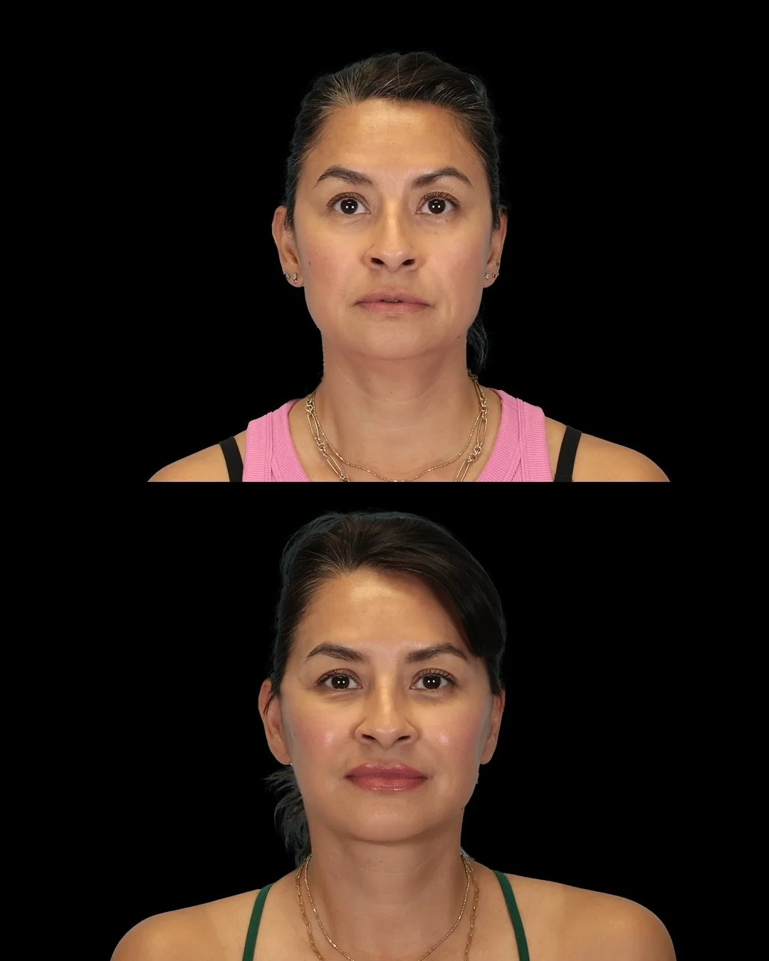 Our patient is in her early 50s and wanted to look like she did 10 years ago—to improve her face, jawline and neck and to restore volume in places she felt she lost them. 
She’s seen here one month out from facial rejuvenation which incl