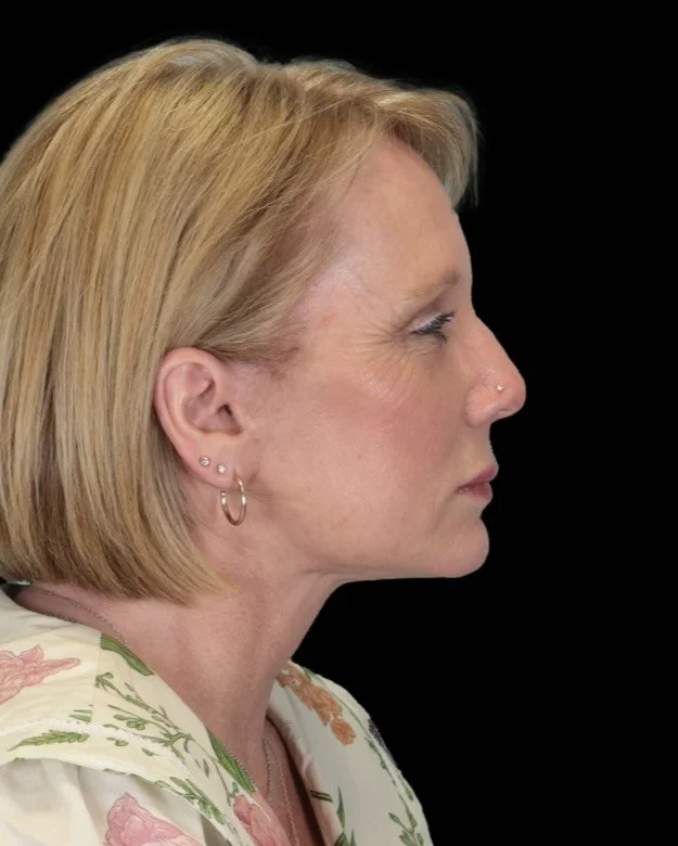 “You look great!” 
“I know.” 
Probably the best response you could ask for from a patient! This patient in her early 60s underwent surgical facial rejuvenation to give her a confident, natural result that speaks for itself.