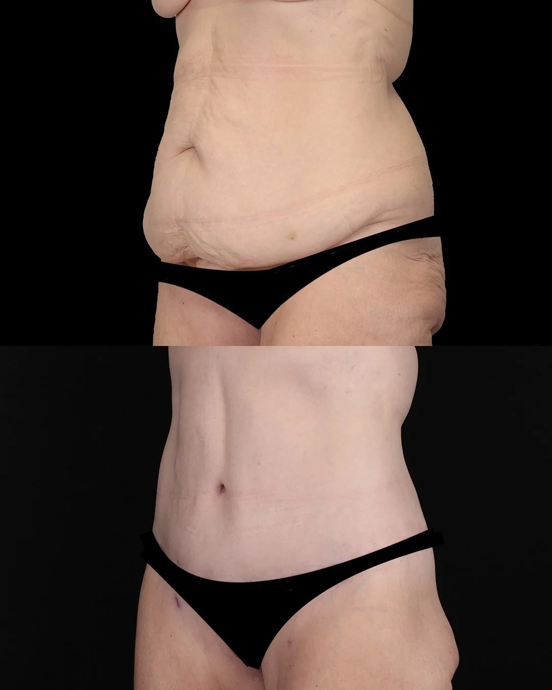 Our patient in her early 60’s is seen here 3 months after a circumferential body lift and thigh liposuction. Age really is just a number. 
#abdominoplasty #tummytuck #lowerbodylift #plasticsurgery 
🥼  Sameer Halani, MD
📞  817-417-7200
✉️ in