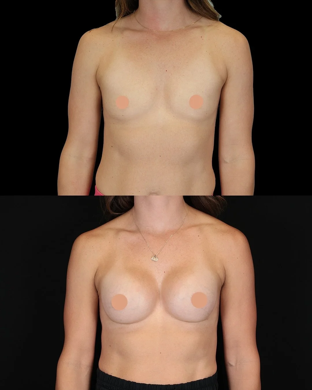 This 34-year-old active mom wanted a modest, natural enhancement that would complement her lifestyle while maintaining balance and proportion. With our rapid recovery protocol, she was back to her routine quickly—achieving harmony without exces