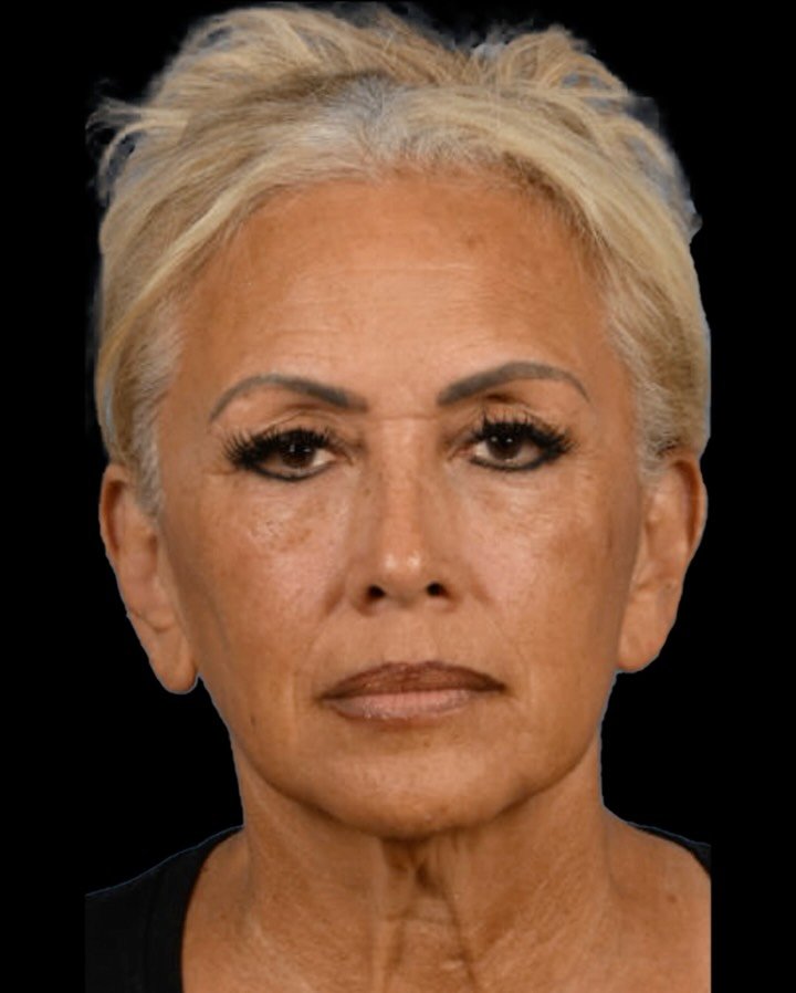 18 months out.

This is what long-term facial rejuvenation should look like &mdash; balanced, natural, and still her. Improved definition through the neck and jawline, restored facial volume, and a softer, more rested appearance overall.

What I love