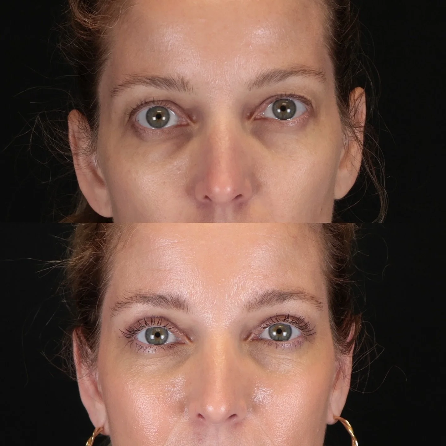 An upper blepharoplasty (eyelid lift) can refresh your look with minimal downtime. This patient is just 2 weeks post-op and already has a beautiful result and it will only get better from here.