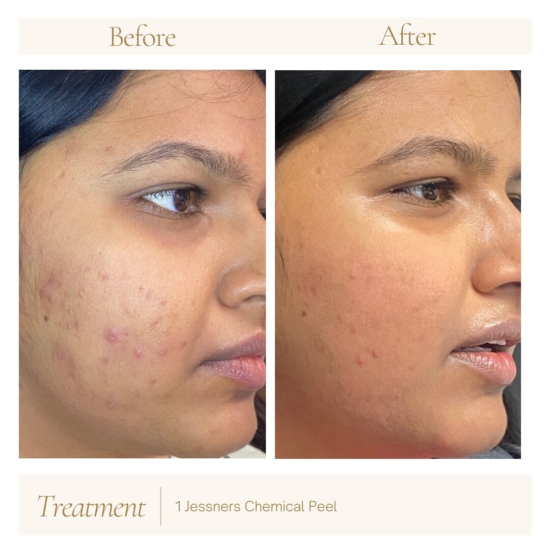 Never underestimate the power of a good chemical peel🙌 Our Jessner Peel is a medium depth peel and is great for acne, acne scarring, sun damage and even aging hands!
.
.
.
.
.
#peel #chemicalpeel #peels #dermatologist #derm #cosmetic #cosmeticderm #