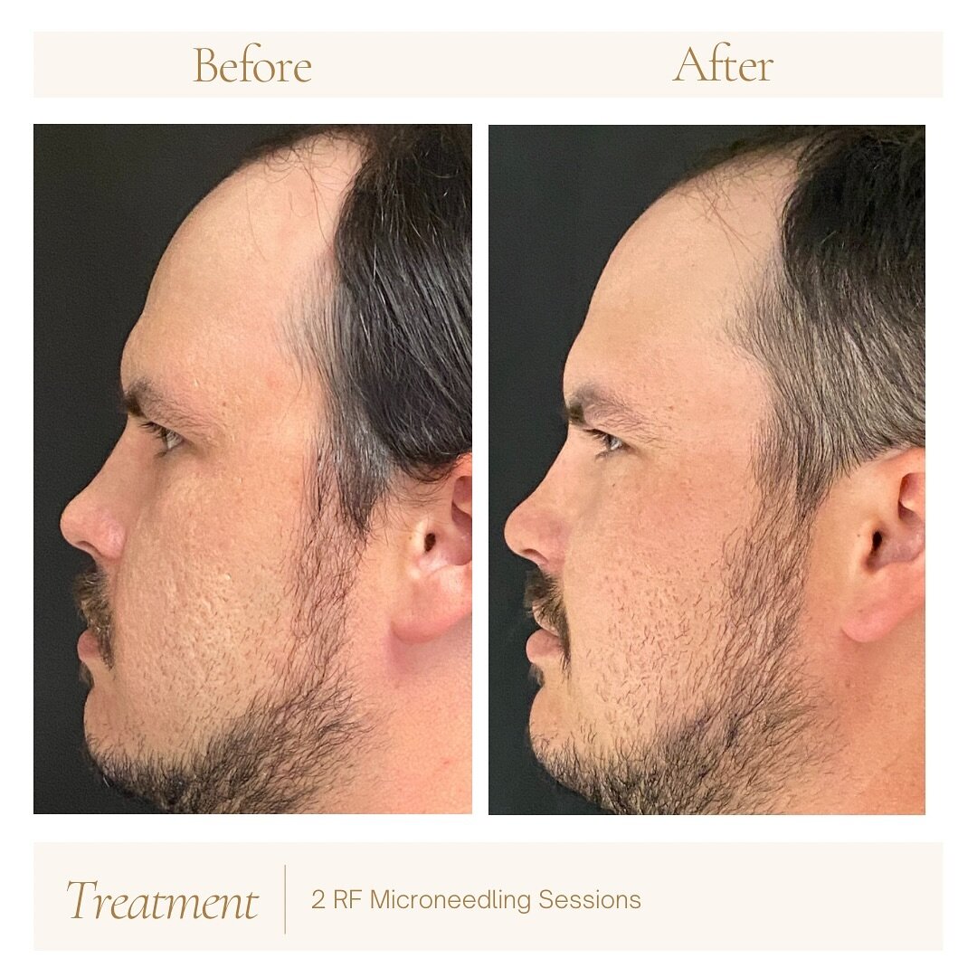 Check out these AMAZING results from Radio Frequency Microneedling! 
.
Our patient wanted to target his acne scarring and overall skin texture- we have seen a huge improvement after just 2 sessions👏🏼 
.
.
.
.
.
#potenza #rfmicroneedling #acnescarri