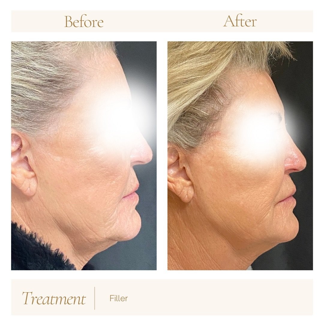 We are coming to you with another amazing Filler before &amp; after! Dr. Brandish strategically injected a combination of @juvederm Hyaluronic Acid Fillers to give our patient a lifted, contoured face✨ Book your Filler appointment today! 
.
.
.
.
.
#
