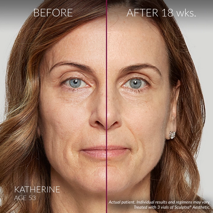 sculptra dermal filler for contouring collagen production increase