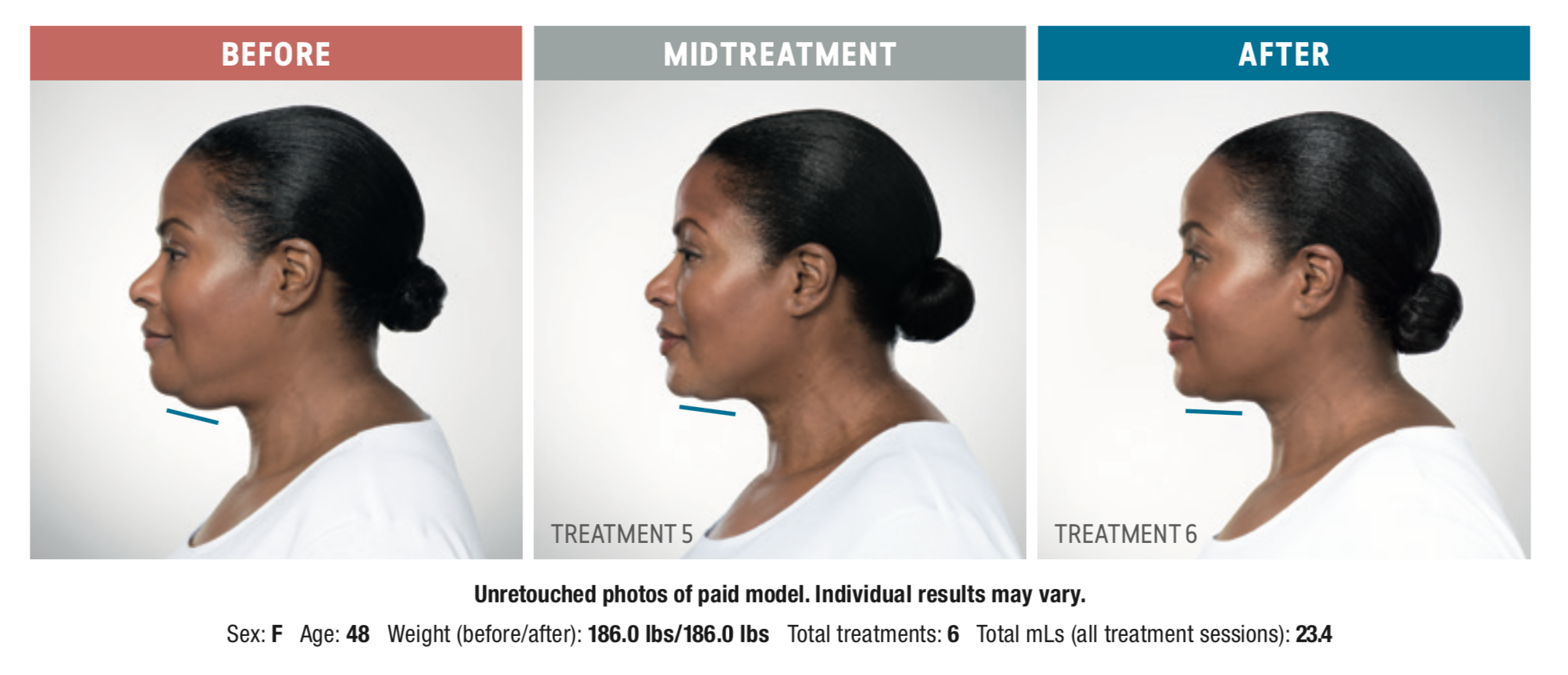 kybella double chin double chin reduction chin