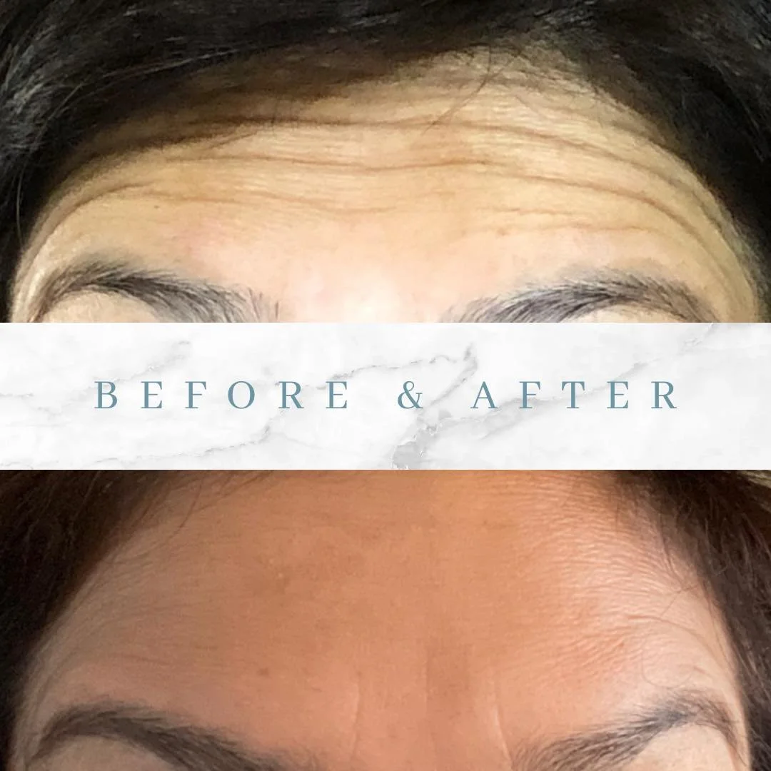 Botox 1.jpg