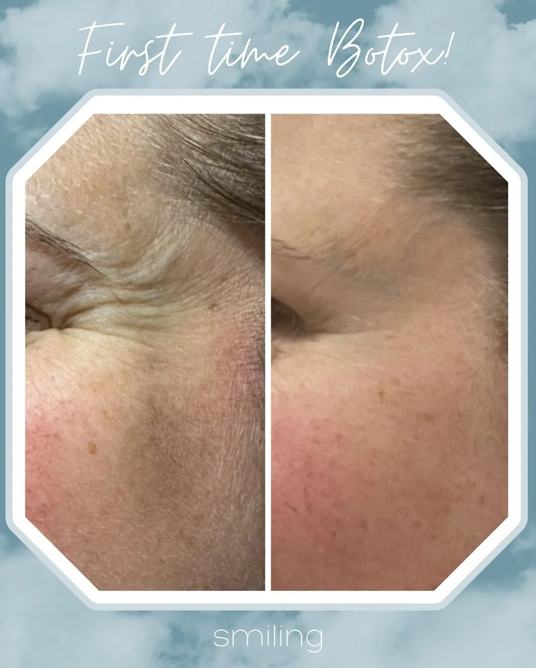 Botox 4.jpg