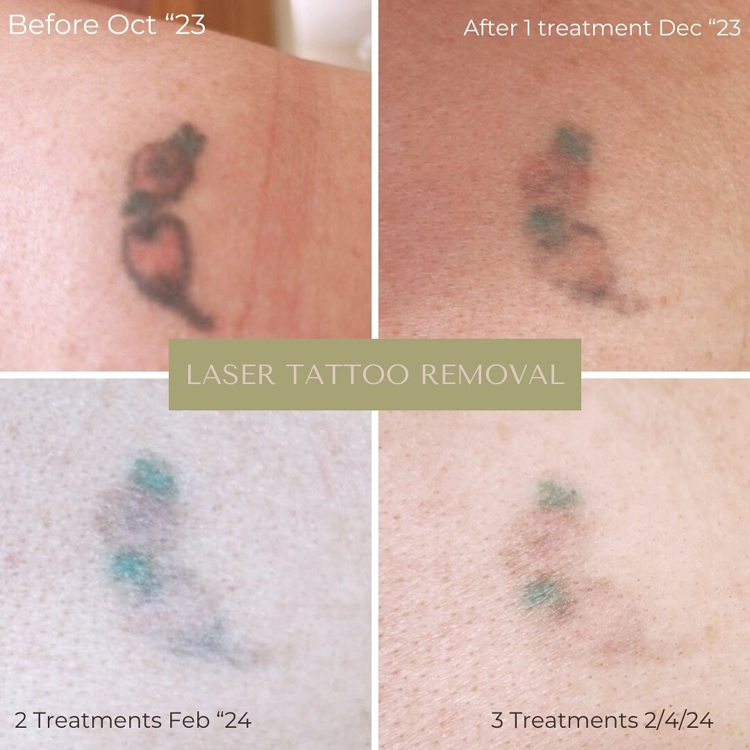 Laser Tattoo Removal - Results so far after 3 treatments 

📍Bantry

💻 Book your Consultation online www.smoothskinandlaserclinic.ie

How many sessions will I need? 
Can be 4 - 10 treatments depending on tattoo

Will it work for me? 
Black ink is th