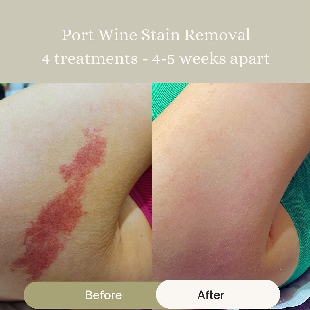 Port Wine stain, birthmarks and other pigmented lesions can be easily and painlessly removed using our laser device with a few simple treatments.

📍Dunmanway 

Consultation: smoothskinandlaserclinic.ie

#candela #ipl #laser #bitthmarkremoval #rednes