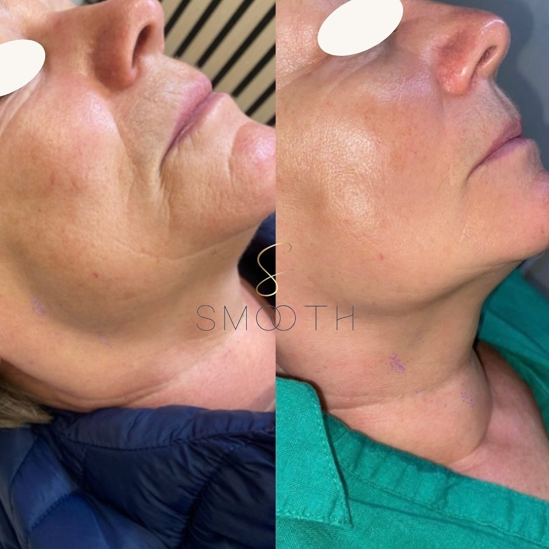 RF Microneedling 👌

Smooth and tighten naturally 

A course of 3-4 treatments and homecare gives best results. This client above has had her 1st treatment check up and follows a homecare plan.

#rfmicroneedling #astra #skincaretips #smooth #tighteni