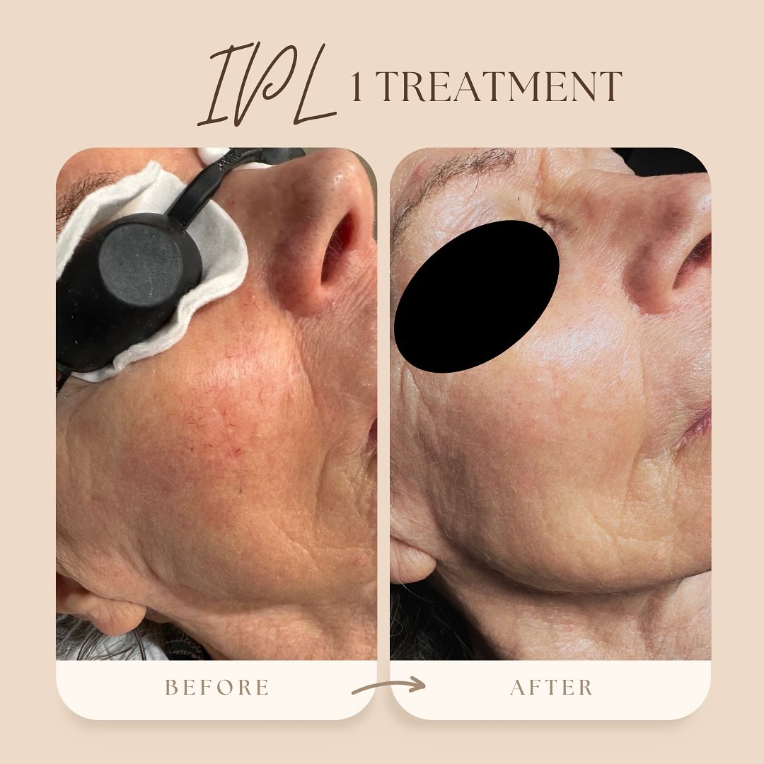 Intense Pulsed Light (IPL) therapy: a non-invasive treatment that reduces pigmentation, improves skin tone, and boosts collagen. Suitable for men &amp; women

Uses:
&bull;Acne.
&bull;Birthmarks.
&bull;Stretch marks.
&bull;Liver or age spots.
&bull;Br