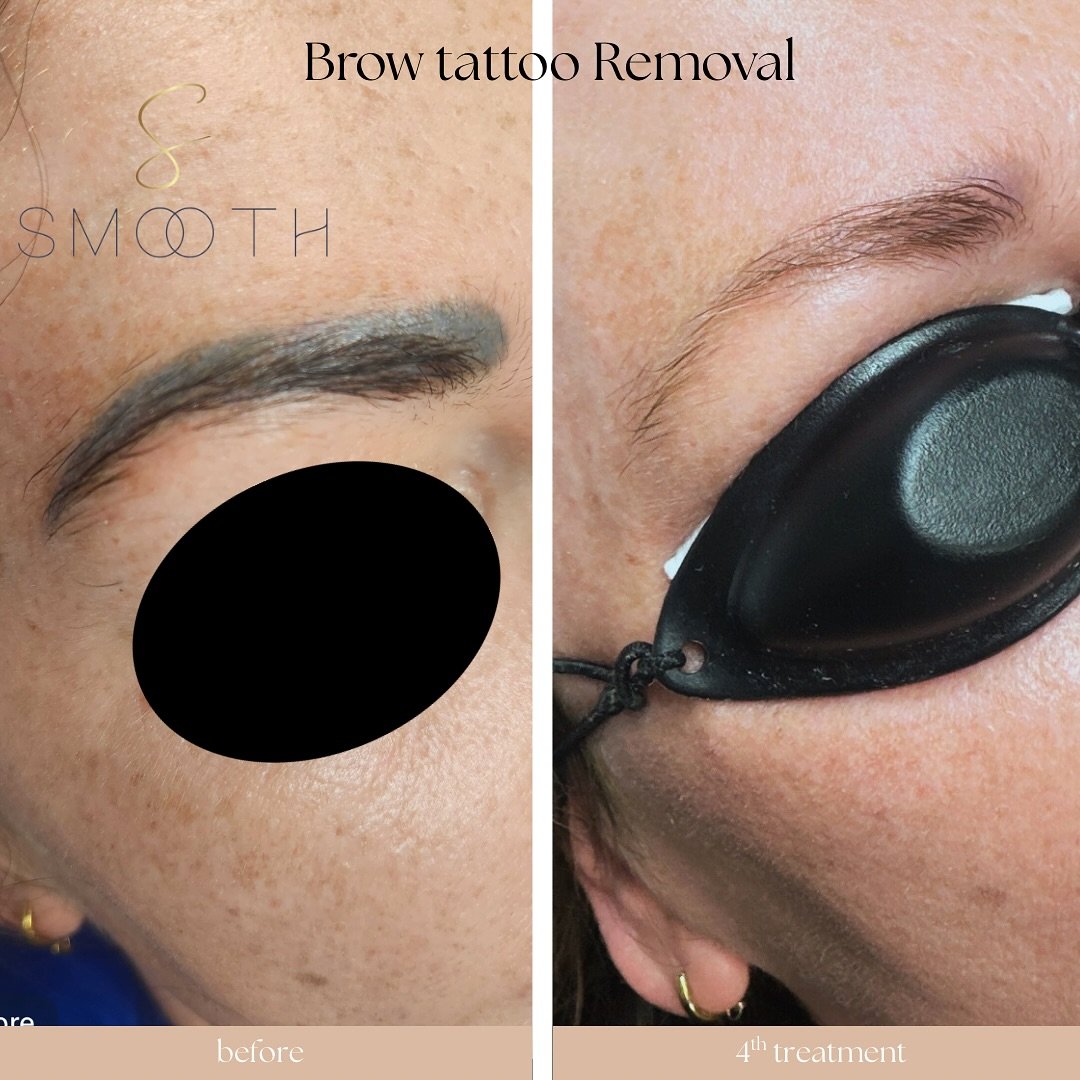 Brow tattoo removal progress. The difference after 4 sessions 🔥. 

(A 5th treatment was carried out to remove the last of the ink after this photo)

Tattoo Removal now available in Smooth Dunmanway. 

Thinking of getting an unwanted tattoo removed?
