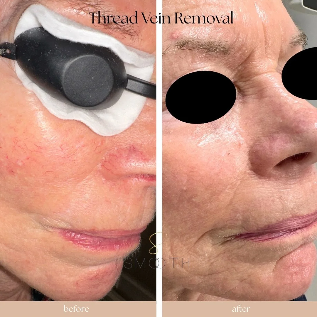 Thread Vein Removal with Candela Nordlys: Say Goodbye to Visible Facial Veins! 
📍Dunmanway 
Book: smoothskinandlaserclinic.ie 
•Thread veins, also known as spider veins, are small, visible blood vessels that commonly appear on the face, part