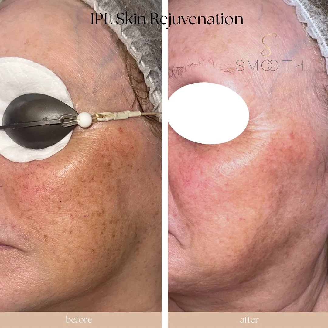 IPL is a superior treatment for hyperpigmentation, sun damage, and vascular concerns.
Q. What will my face look like after IPL?
Once the initial shedding phase is over, your skin feels softer and looks more radiant. Pore size may appear smaller, and