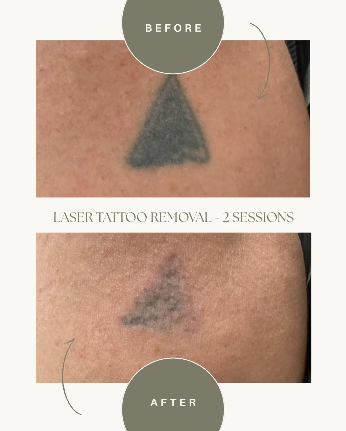 Thinking About Tattoo Removal?

Tattoo removal is safe, effective, and more advanced than ever. If your tattoo no longer fits your lifestyle, you have options ✨

How it works:
Laser tattoo removal breaks down ink particles in the skin so your body ca