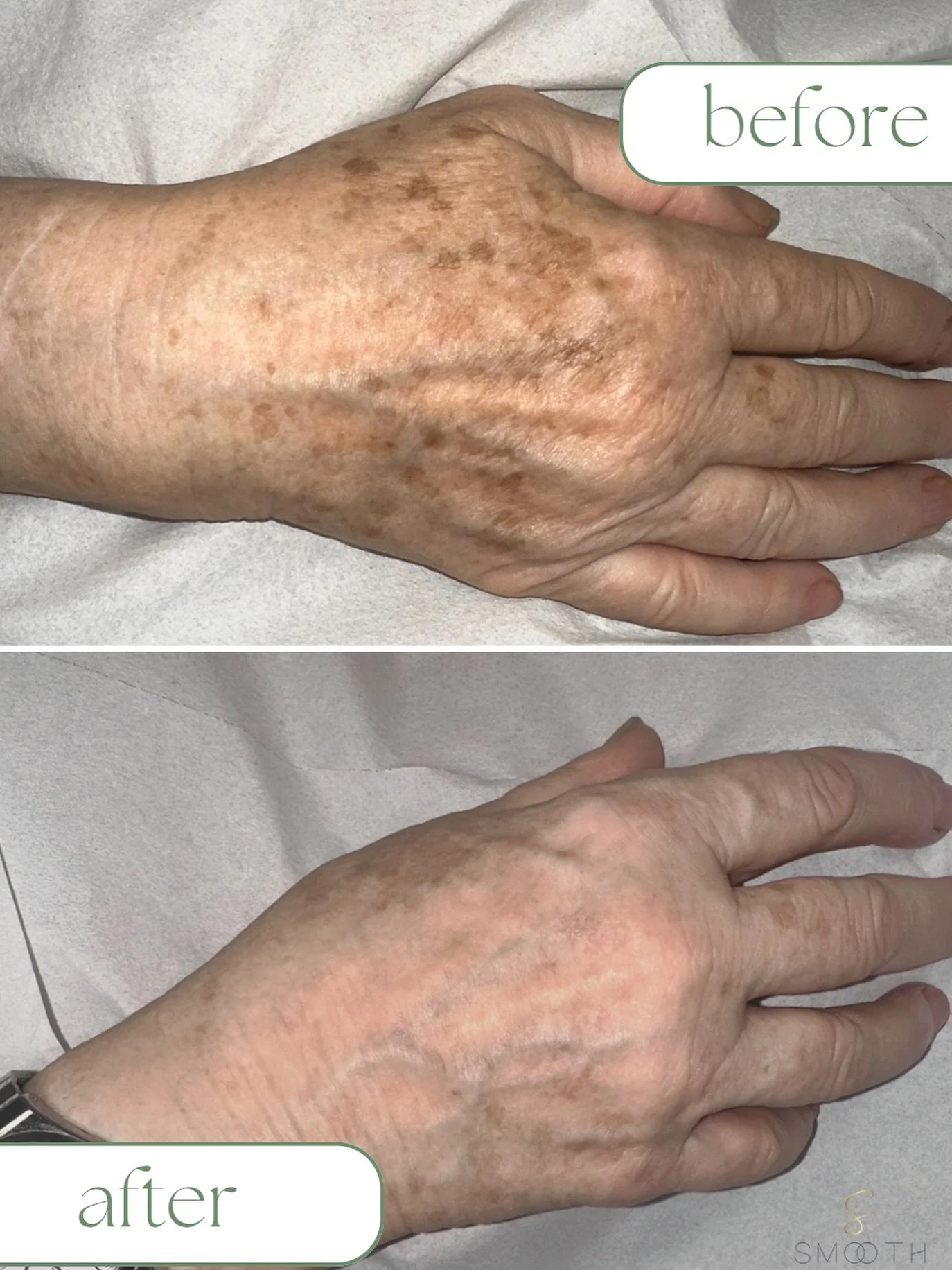 Age/sun spots removal using Q10 laser . Can be performed anywhere on the body or face.
Consultation needed before full treatment.

#laser #qswitch #sunspots #agespot #pigmentation #westcork #laserclinic #beautyclinic