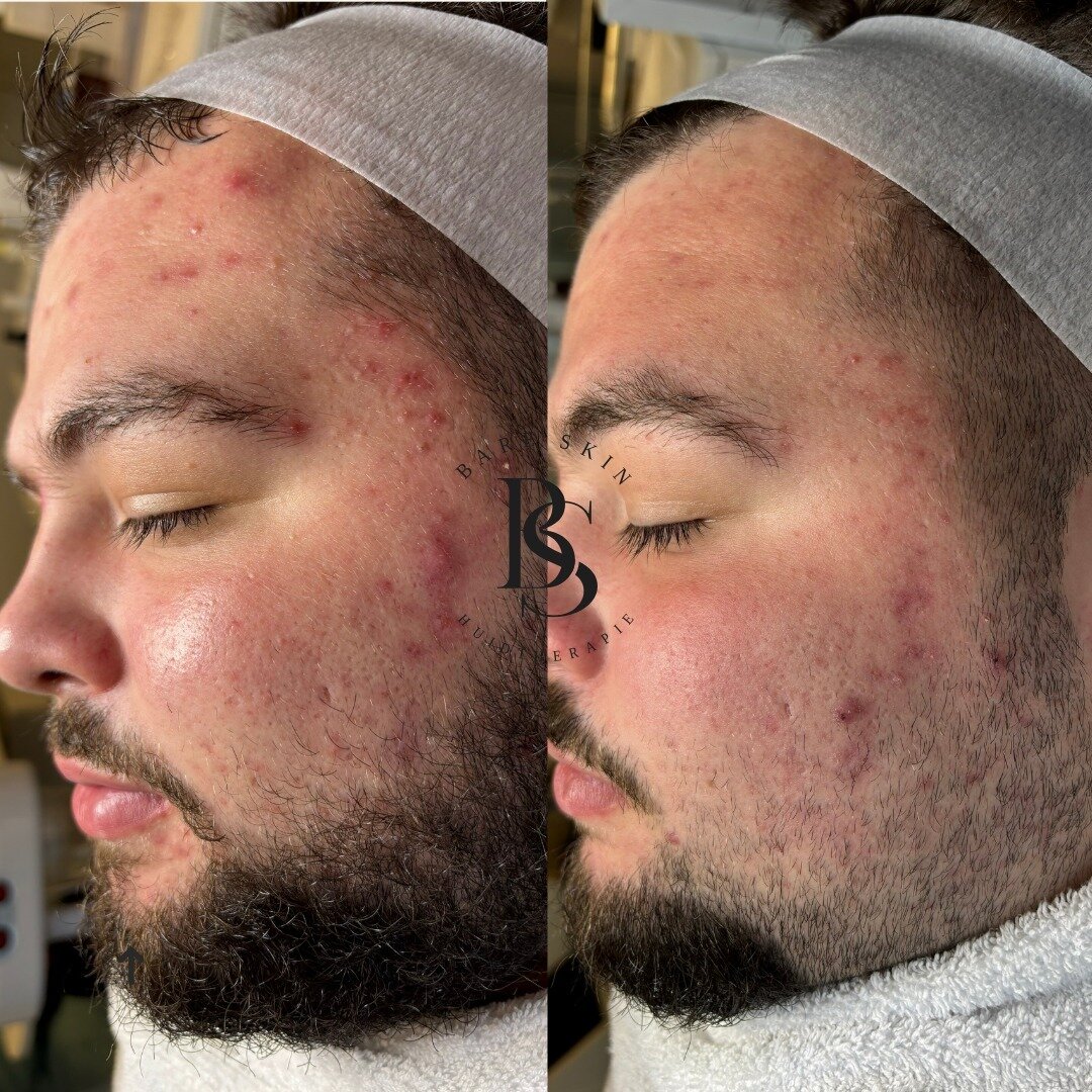 Tussentijds resultaat 🙌

Deze klant had last van actieve acne, die we volledig hebben verminderd met behulp van chemische peelings. Nu de acne onder controle is, gaan we intensief aan de slag met micro needling behandelingen om de littekens te vermi