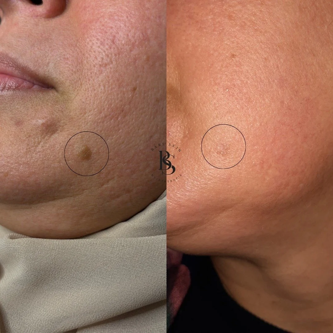 Wist je dat goedaardige huidoneffenheden ook gemakkelijk met onze Lutronic Clarity II behandeld kunnen worden? 

De laser verwarmt de huidoneffenheid laag voor laag, wat resulteert in verdamping van de laesie en de vorming van een korstje. Het is bel