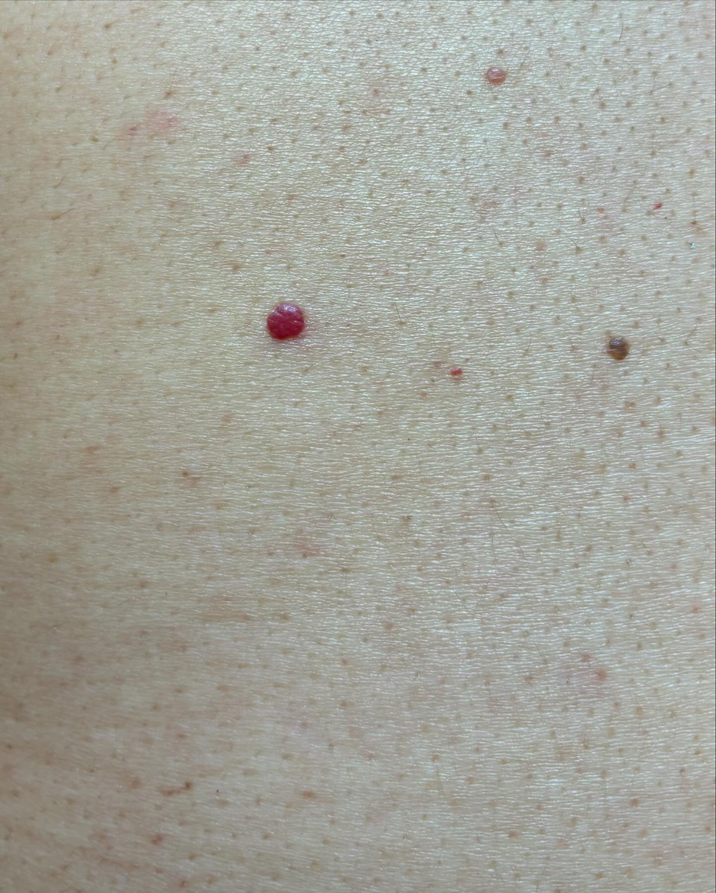 Cherry angiomen, ook wel kersenwratjes genoemd, zijn kleine, rode bultjes die vaak op de romp, armen en benen verschijnen. Ze kunnen zowel plat als verheven zijn, en hoewel ze onschuldig zijn, worden ze soms als cosmetisch storend ervaren. Beide type