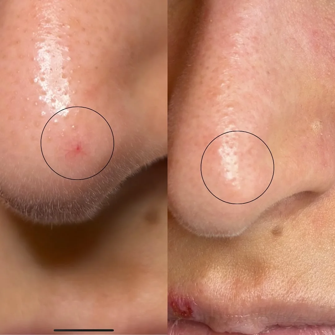 Na slechts &eacute;&eacute;n behandeling met onze Nd:YAG-laser is de spider naevus verdwenen! 😍

Een spider naevus is een rood &ldquo;spinnetje&rdquo; van verwijde bloedvaatjes op de huid. Onze laser stuurt gerichte energie naar deze vaatjes, waardo